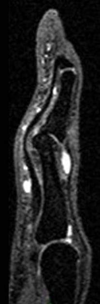 Figure 3 for case volar plate tear of proximal interphalangeal joint of finger ( RID2413 )